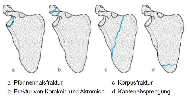 <p>a) Pfannenhalsfraktur</p><p>b) Fraktur von Korakoid &amp; Akromion</p><p>c) Korpusfraktur</p><p>d) Kantenabsprengung</p><p>c) &amp; d) relativ selten - eher konservative Behandlung</p>