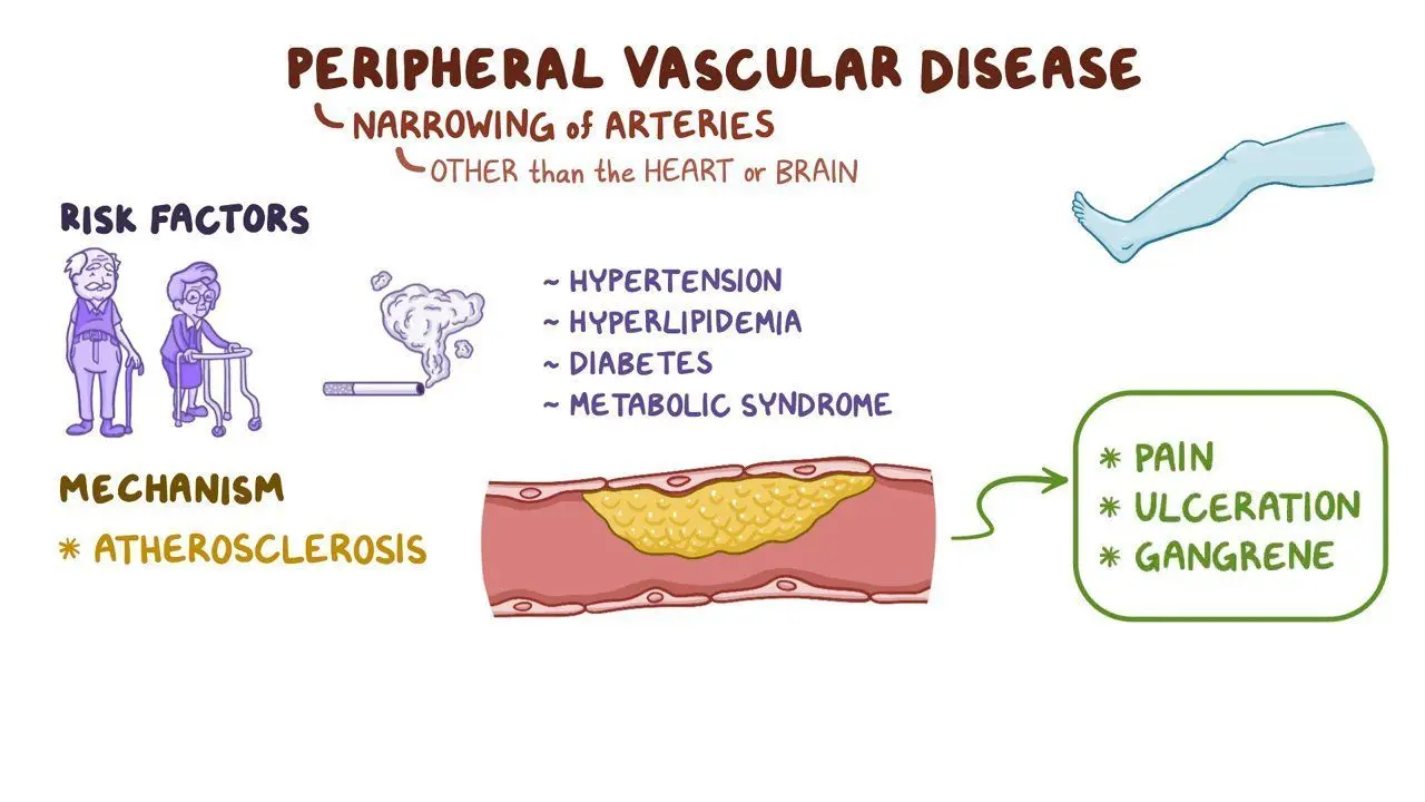 <ul><li><p>Also called <strong>Peripheral Arterial Disease (PAD)</strong></p></li><li><p><strong>arteries supplying the limbs</strong>, especially the <strong>legs</strong>, become narrowed or blocked </p></li><li><p>due to <strong>atherosclerosis</strong></p></li><li><p>results in <strong>poor circulation</strong></p></li><li><p><strong>Pathophysiology:</strong></p><ul><li><p>Atherosclerosis in <strong>peripheral arteries</strong></p></li><li><p>↓ Blood flow to limbs, especially during exercise</p><p>→ <strong>Ischaemic muscle pain</strong></p></li></ul></li><li><p><strong>Clinical Presentations:</strong></p><ul><li><p><strong>Intermittent claudication</strong>: </p><ul><li><p>Cramping leg pain during walking</p></li><li><p>relieved by rest</p></li></ul></li><li><p><strong>Critical limb ischaemia</strong>: </p><ul><li><p>Pain at rest</p></li><li><p>non-healing ulcers</p></li><li><p>gangrene</p></li></ul></li><li><p><strong>Diminished pulses</strong>:</p><ul><li><p>cool or pale skin</p></li><li><p>poor wound healing</p></li></ul></li></ul></li></ul><p></p>