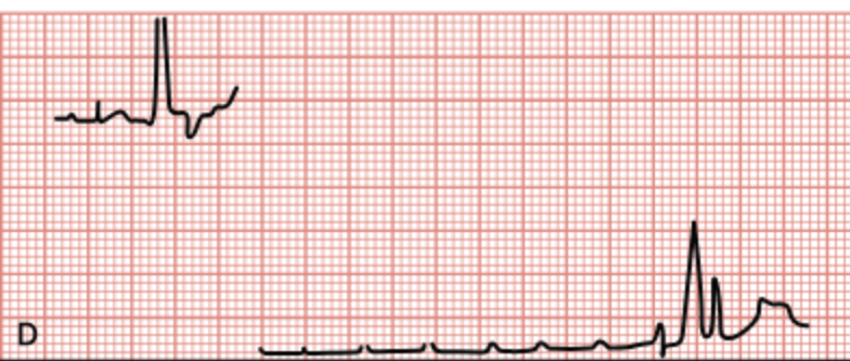 <p>Break in the tracing, usually related to a disconnected or broken lead wire.</p>