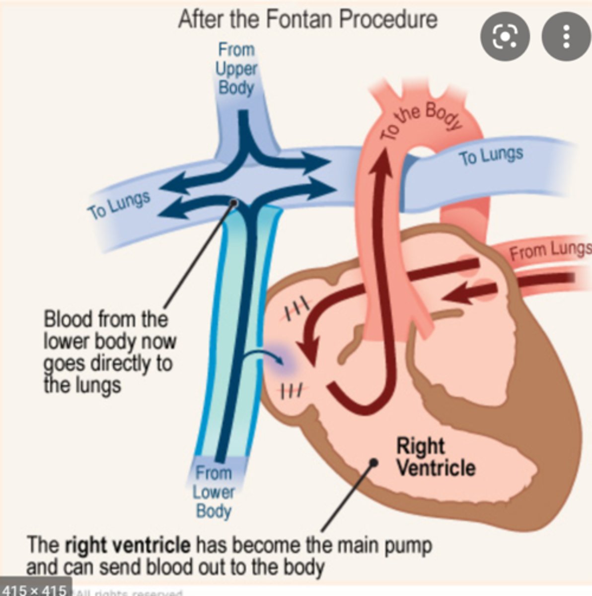 <p>STAGE 3</p><p>(~2-4 years)</p><p>• Goals: Direct ALL venous return passively to lungs; bypass entire right heart</p><p>• IVC REDIRECTED directly to pulmonary artery (joins SVC connection)</p><p>• IVC closed off from right atrium</p><p>• Result: ALL venous blood (SVC + IVC) bypasses right heart → flows passively to lungs</p><p>• RV pumps ONLY to body (systemic output — its most important job)</p><p>• Heart functions as "two-chamber heart": one functional combined atrium (via ASD), one functional ventricle (RV)</p><p>• Lungs filled PASSIVELY — no right ventricle pumping blood to lungs</p><p>• Outcomes: Good chance of surviving into adulthood</p>
