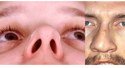 <ul><li><p>occurs when the thin wall that makes up the nasal septum inside the nose is displaced to one side</p></li><li><p>nasal septum separates the right and left nasal cavities</p></li></ul><p></p>