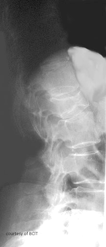 <p>How are pathological fractures treated?</p>