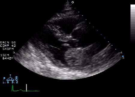 <p>The image above demonstrates a benign primary cardiac tumor.&nbsp; The most likely diagnosis is which of the following?</p><ul><li><p>right atrial myxoma</p></li><li><p>left atrial myxoma</p></li><li><p>right atrial hemangioma</p></li><li><p>left atrial hemangioma</p></li></ul><p></p>