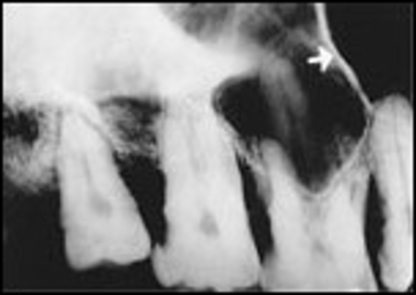 <p>What is the radiopaque structure seen here?</p>