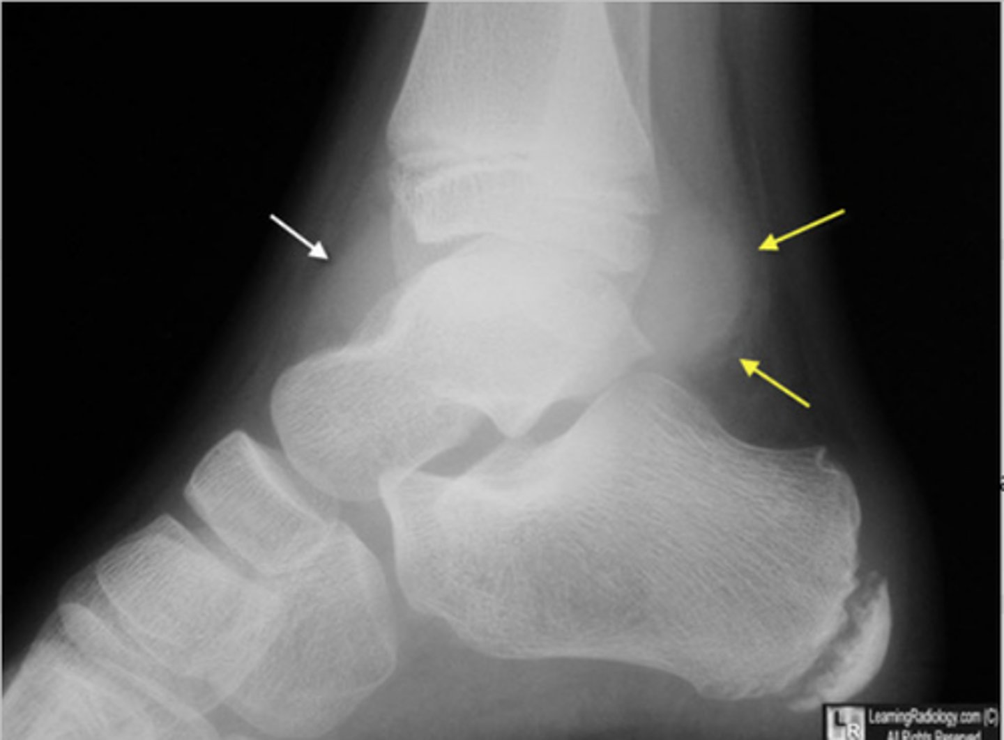<p>An <strong>__________</strong> appears as an anterior fat line in front of the joint space on the lateral view</p>