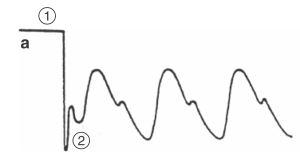 <p>“A-line for the right side of the heart”</p><ul><li><p>tip of catheter sitting in pulmonary artery</p></li><li><p><strong>SBP/DBP = 15-25/8-15</strong></p></li><li><p>high: atrial/septal defect, pulmonary HTN, LV Failure, mitral stenosis/regurgitation</p></li></ul><p></p>