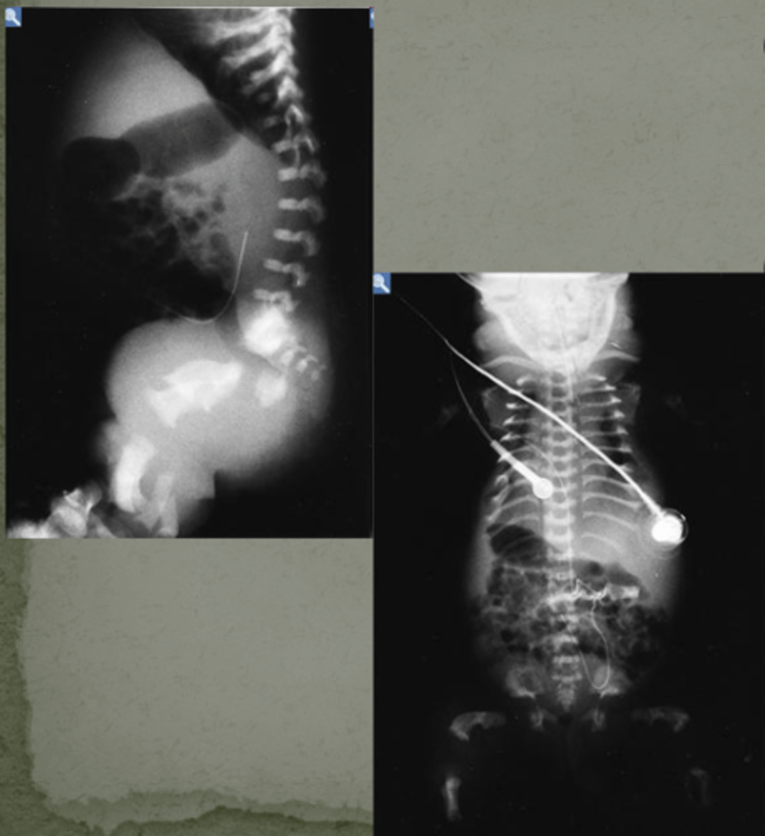 <p>Thanatophoric dysplasia (type of skeletal dysplasia)</p><p>(small ribcage so too constrictive for lungs)</p>