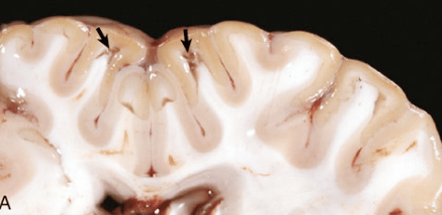 <p>What type of necrosis is being shown in this image?</p>