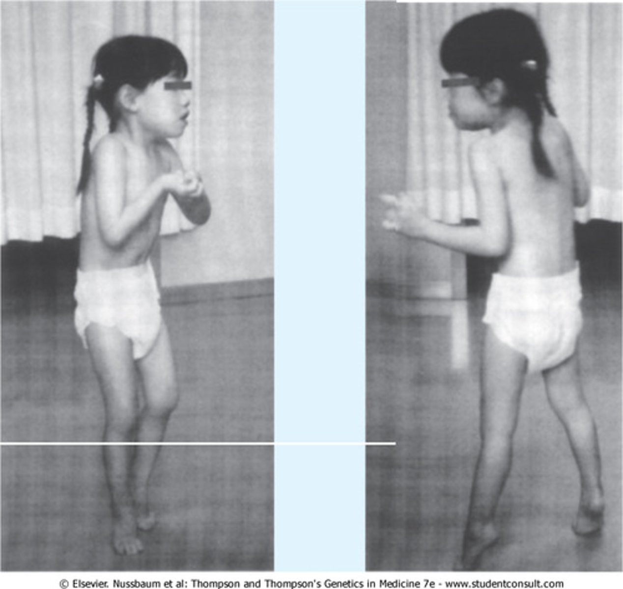 <p>caused by mutation in X chromosome </p><p>(almost always seen in GIRLS)</p><p>*often misdiagnosed as autism</p><p>CHARACTERIZED BY:</p><p>- deceleration of head growth</p><p>- loss of skills after 6-18 months</p><p>- scoliosis</p><p>- growth failure</p><p>- hyperventilation and breath holding</p>