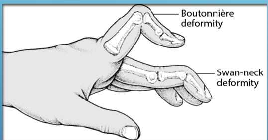<p>Deformities are usually Boutonniere or Swan Neck.</p><p>Synovitis of the joints leads to a shortening of the collateral ligaments and stretching of the joint capsule.</p><ul><li><p>lateral bands displace palmarly thus the Boutonniere deformity.</p></li><li><p>lateral bands are displaced dorsally thus the Swan neck deformity&nbsp;</p></li></ul><p></p>