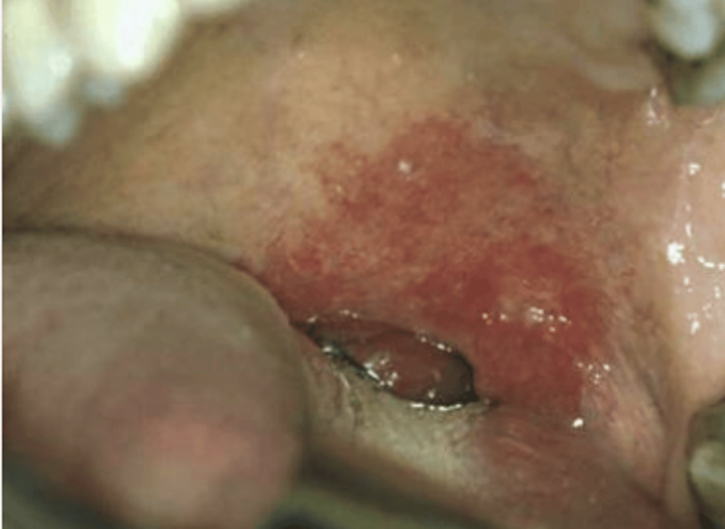 <p>Red plaque or patch that cannot be clinically identified or pathologically diagnosed as any other condition</p>