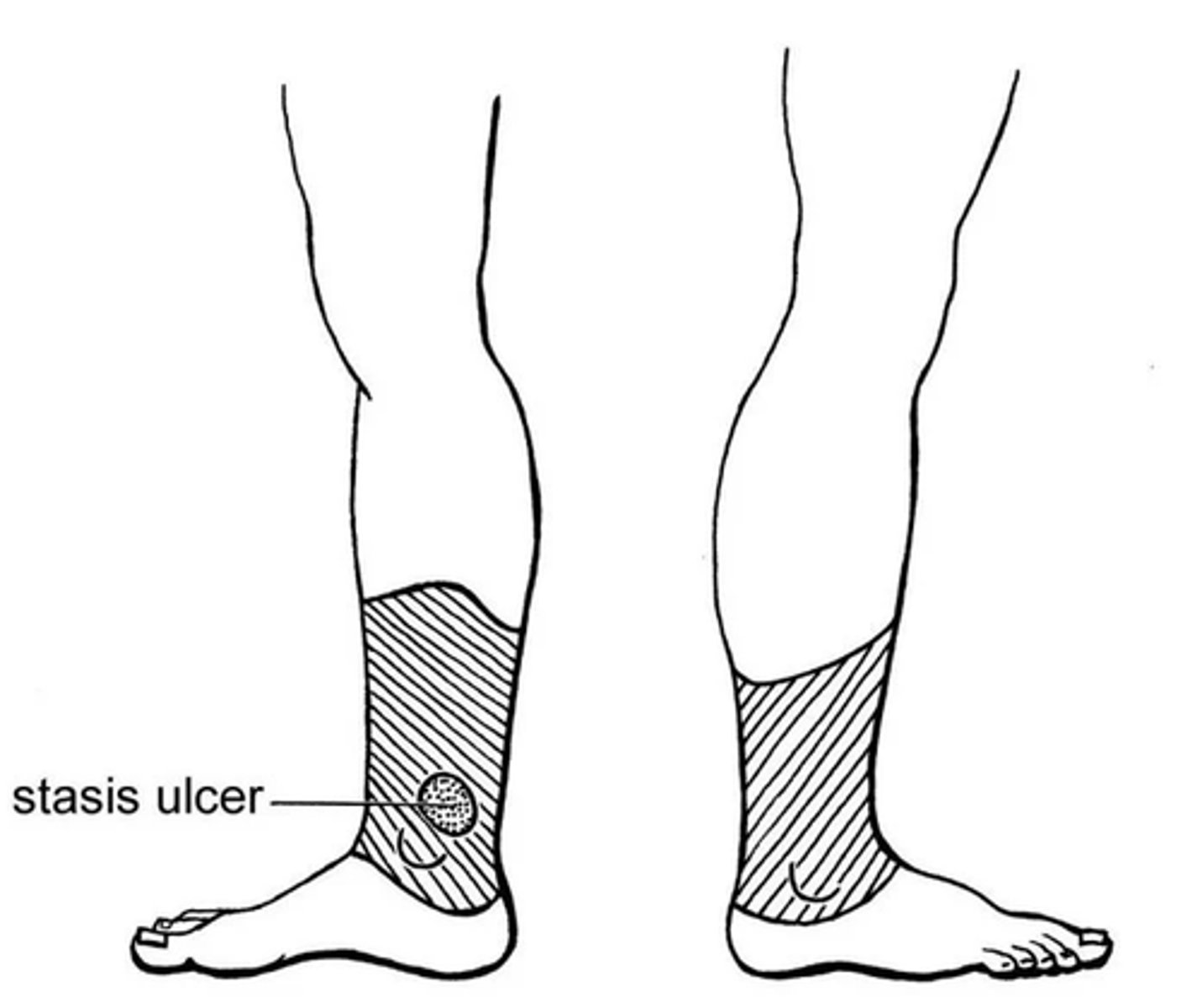 <p>A = Distal ulcer (ON TOES AND WEB SPACES, can lead to gangrene)</p><p>V = Shallow ulcers in gaiter distribution, usually medial</p>