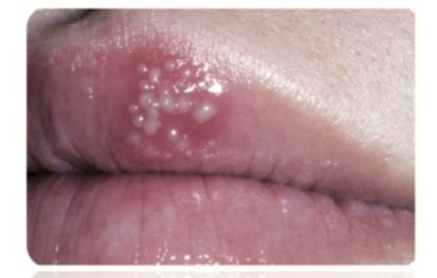 <p>cold sores</p><p>grouped vesicles w/erythematous base caused by secondary recurrent HSV-1</p><p>usually reoccur at the same site, mucocutaneous junction of lip MC</p><p>may follow stress, illness, sun exposure</p>
