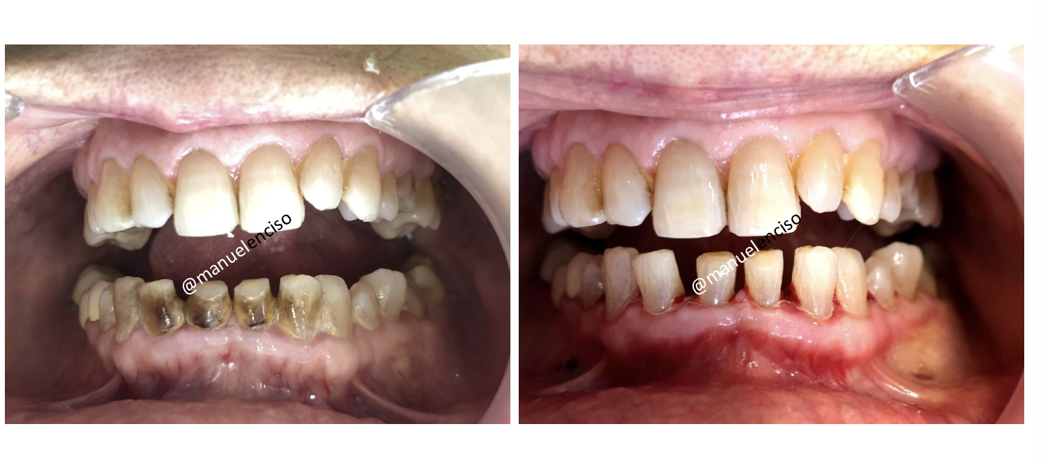 <p><span style="font-size: calc(var(--scale-factor)*21.80px);"><span>• Periodontal diseases reflects AN INFLAMMATORY TISSUE RESPONSE of the insertion tissue of</span></span><span><span><br></span></span><span style="font-size: calc(var(--scale-factor)*21.77px);"><span>the tooth, to the bacterial accumulation at the subgingival level.</span></span><span><span><br></span></span><span style="font-size: calc(var(--scale-factor)*21.77px);"><span>• It appears in two forms: GINGIVITIS AND PERIODONTITIS.</span></span><span><span><br></span></span><span style="font-size: calc(var(--scale-factor)*21.77px);"><span>• The etiology of these processes is complex.</span></span><span><span><br></span></span><span style="font-size: calc(var(--scale-factor)*21.77px);"><span>• The diseases are the result of the disequilibrium between the host and subgingival biofilm, so</span></span><span><span><br></span></span><span style="font-size: calc(var(--scale-factor)*21.77px);"><span>they can be framed within the hypothesis of the ecological plaque.</span></span><span><span><br></span></span><span style="font-size: calc(var(--scale-factor)*21.80px);"><span>• In this way, ENVIRONMENTAL CHANGES ON THE PLAQUE, such as the ones originated from</span></span><span><span><br></span></span><span style="font-size: calc(var(--scale-factor)*21.77px);"><span>smoking, can lead to changes in the subgingival microbiota.</span></span><span><span><br></span></span><span style="font-size: calc(var(--scale-factor)*21.80px);"><span>• In other changes in the subgingival environment, genetic factors are involved. (eg, neutrophil</span></span><span><span><br></span></span><span style="font-size: calc(var(--scale-factor)*21.77px);"><span>defect). </span></span></p>