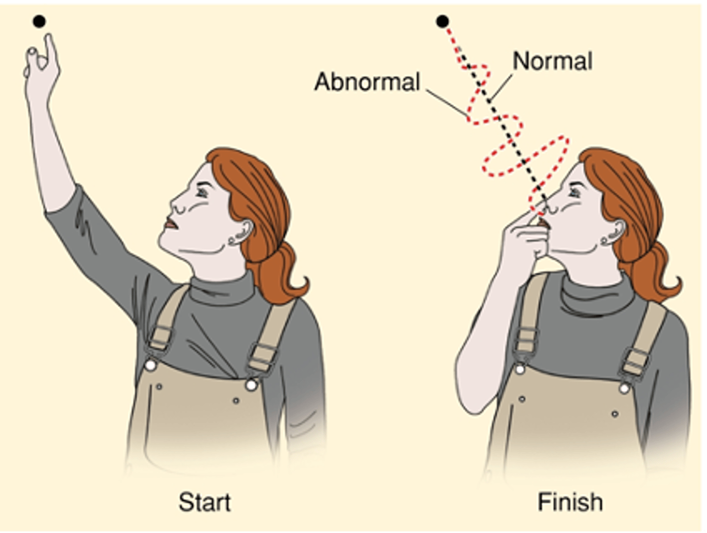 <p>Even a simple task like touching your nose requires co-ordination of multiple muscles and joints in sequence - In ataxia this ability is lost, what is this called?</p>