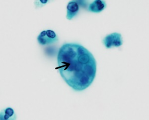 <p>single nucleus with leukocytes in the cytoplasm</p>