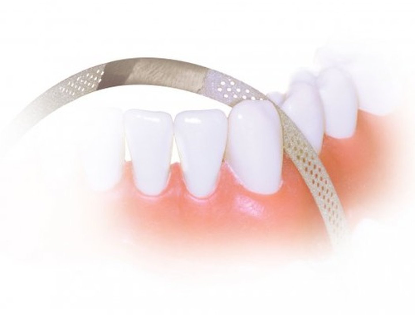 <p>strips incisor contacts to allow realignment</p>