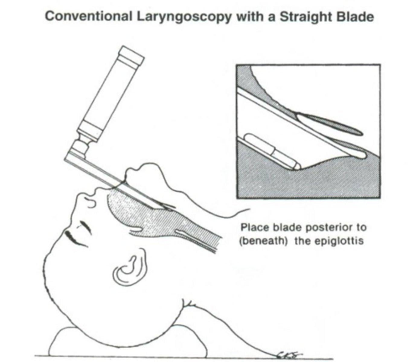 <p>Push blade deep</p><p>Epiglottis is being pinned to the anterior laryngeal wall</p>