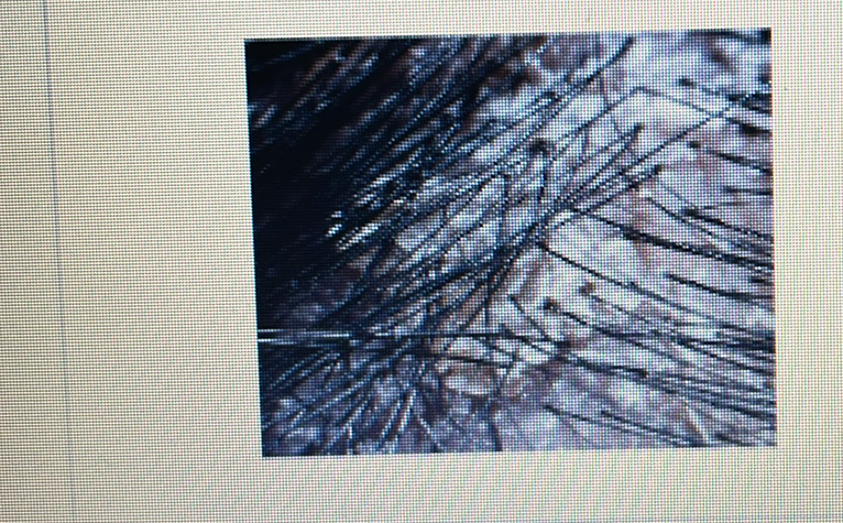 <p>HAIR DISORDER</p><p><span style="font-family: Calibri, sans-serif"><strong>Dandruff: It causes white or yellow flakes on your scalp and hair shaft. It’s also known as seborrheic dermatitis.</strong></span></p>