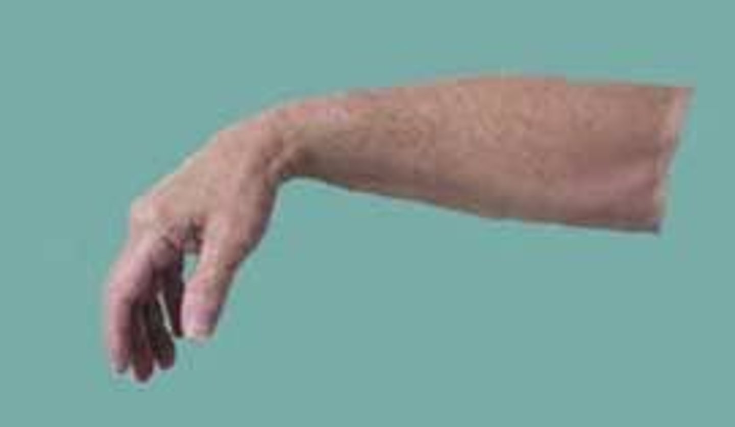 <p>Radial nerve can become damaged by humeral fractures involving the spiral groove (mid-shaft).</p><p>This leads to wrist drop & reduced grip strength</p><p>Anaesthesia of the 1st dorsal web space</p>