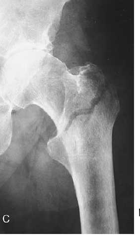 <p>fracture that occurs between the greater and lesser trochanters of the hip</p>