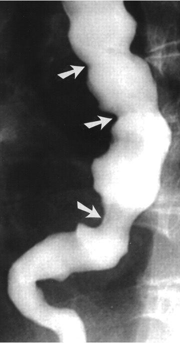 <p>What condition?</p><ul><li><p>simultaneous uncoordinated, non propulsive contractions of segments of esophagus</p></li><li><p>prevents normal movement of food bolus</p></li><li><p>seen in 5% patients w/ unexplained CP</p></li><li><p>unknown cause</p></li><li><p>corkscrew appearance</p></li><li><p>excellent prognosis</p></li></ul><p></p>