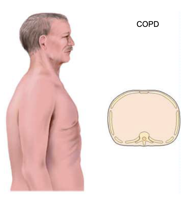 <p>abnormal, COPD </p>