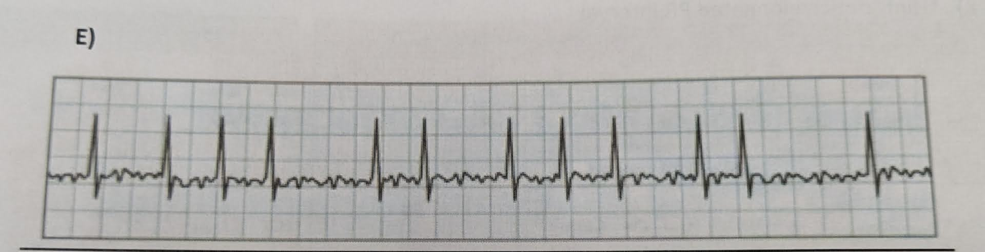 <p>identify the ECG abnormalities (if any)</p>