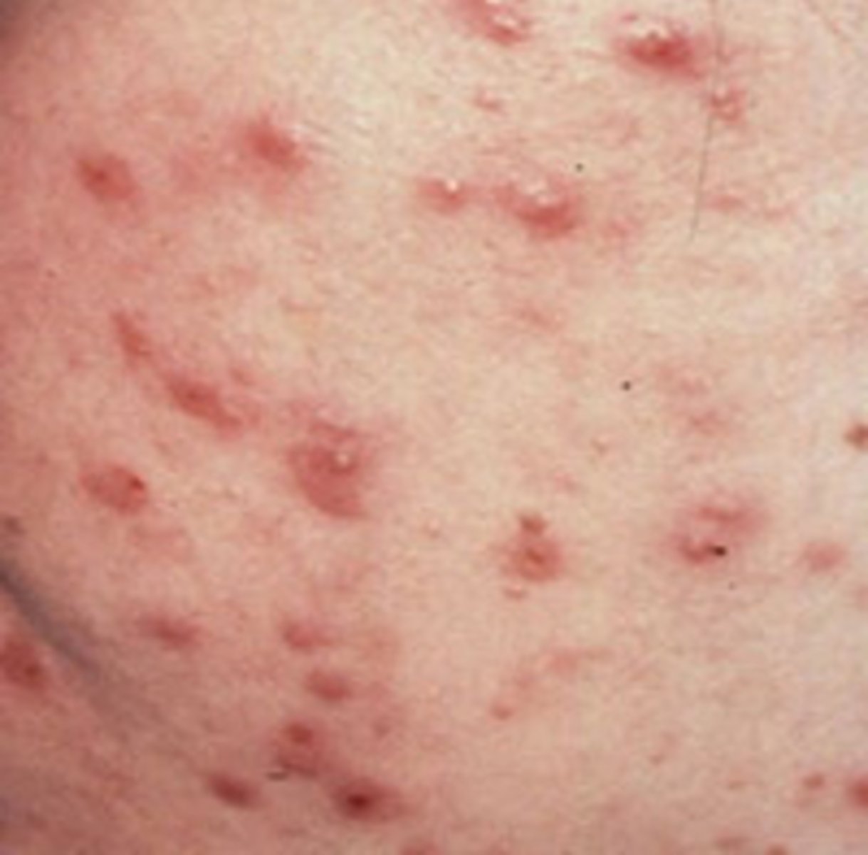 <p>_________________:</p><p>• Inflammation</p><p>• Infected/ abraded skin</p><p>• Accumulated secretions</p><p>• Infection</p><p>• Disseminated histoplasmosis</p><p>• Hypertrophy of skin cells</p><p>• Acne</p>