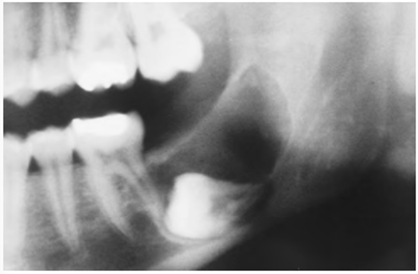 <p>• unilocular/multilocular radiolucency</p><p>• usually associated with unerupted tooth (75%)</p>