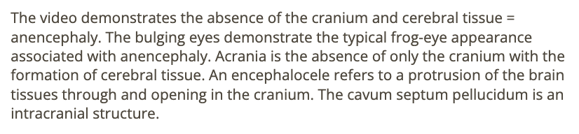 <p>d) anencephaly</p>