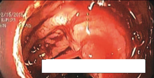 Hemorragia intestinal