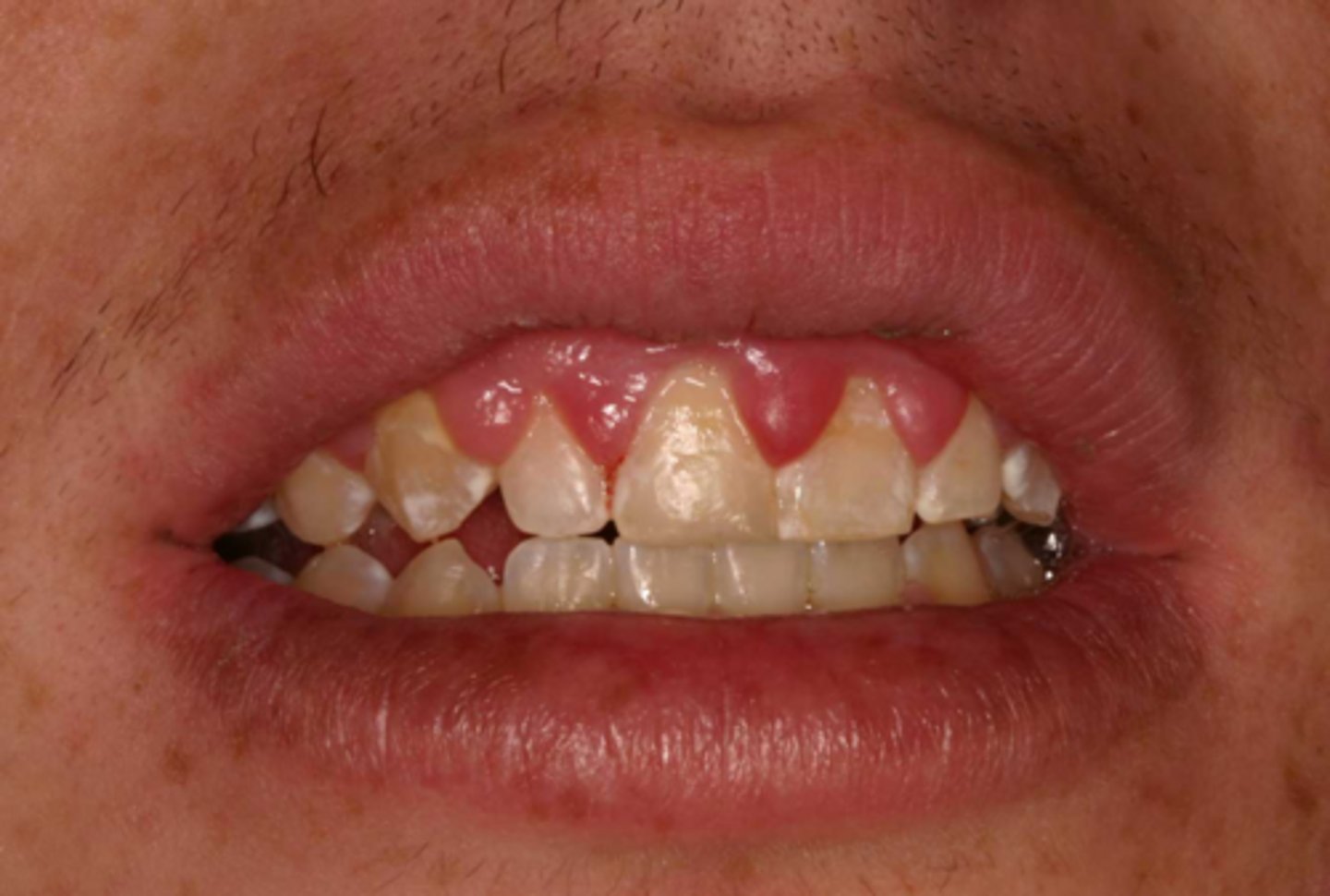 <p>drug-related gingival hyperplasia</p>