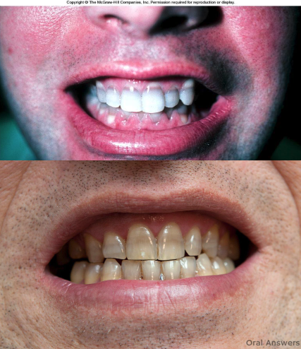 <p>tooth discoloration</p>