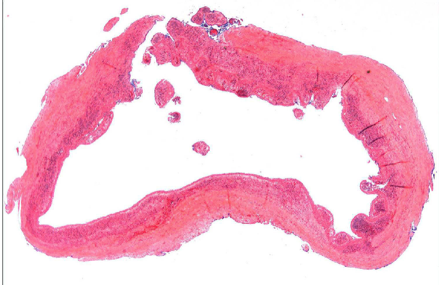 <ol><li><p>lining of cyst composed of <strong>stratified squamous epithelium</strong></p></li><li><p>wall of cyst consists of <strong>dense fibrous tissue w/ inflammatory infiltrate</strong></p></li></ol><p></p>