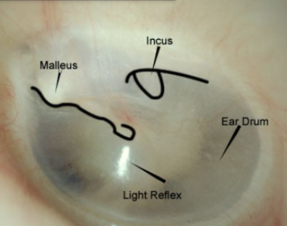 <p>Hand-held otoscopes are used for inspection of the outer ear, ear canal, and tympanic membrane</p><p>Some disorders may be suggested by the appearance of the tympanic membrane</p><p>Shining a light allows some of the structures of the middle ear to become visible (because the tympanic membrane is semitransparent) — cone of light</p><p>Malleus, Incus, ear drum… want to see these and the light reflex</p>