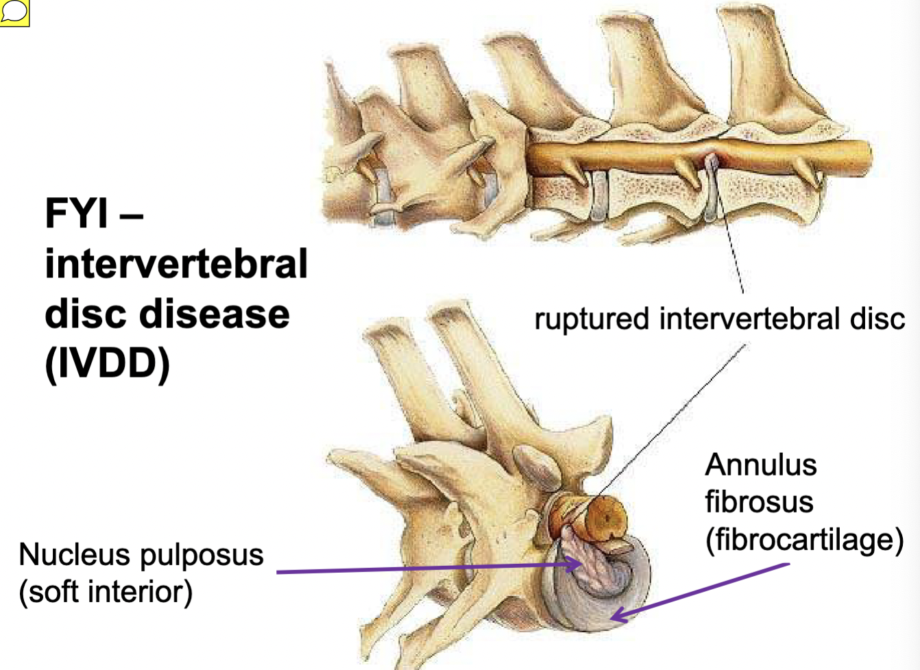 <p>Annulus fibrosus &amp; nucleus pulposus = fibrocartilaginous jt</p>