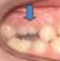 <p>depression/below line of occlusion </p>