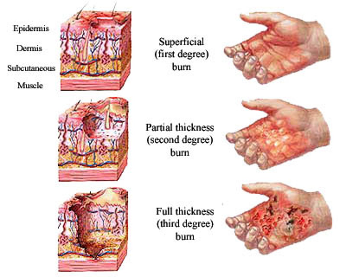 <p>1. superficial</p><p>2. superficial dermal (superficial partial thickness)</p><p>3. deep dermal (deep partial thickness)</p><p>4. full thickness</p>