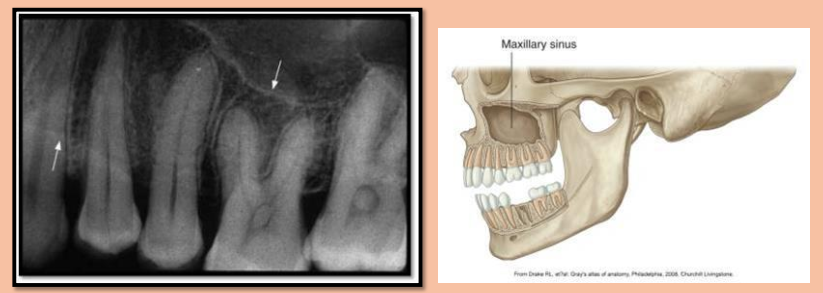<ul><li><p>Radiolucent</p></li><li><p>Ex. Maxillary sinus </p></li></ul><p><em>**when sinuses are infected, they will appear more radiopaque (grayish or white within the sinus area on xray) </em></p>