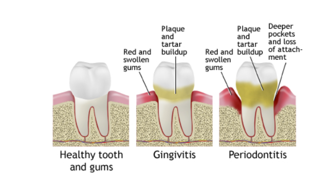 <ol start="2"><li><p>periodontal disease (gingivitis and periodontitis)</p></li></ol><p></p>