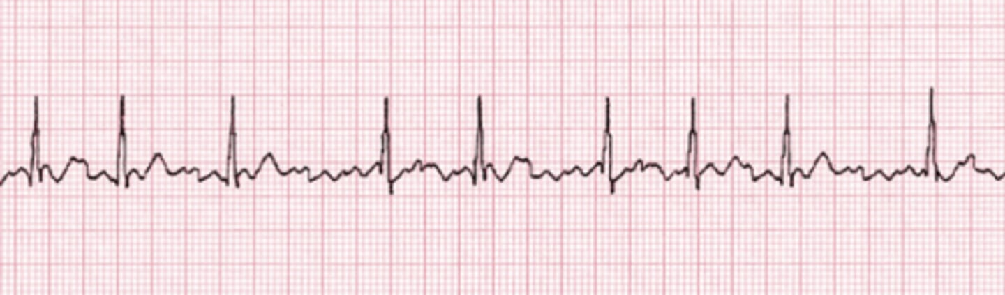 <p>Absence of discrete P waves and presence of irregularly irregular QRS complexes.</p><p>The two key features of atrial fibrillation on ECG are the absence of discrete P waves and the presence of irregularly irregular QRS complexes.</p>