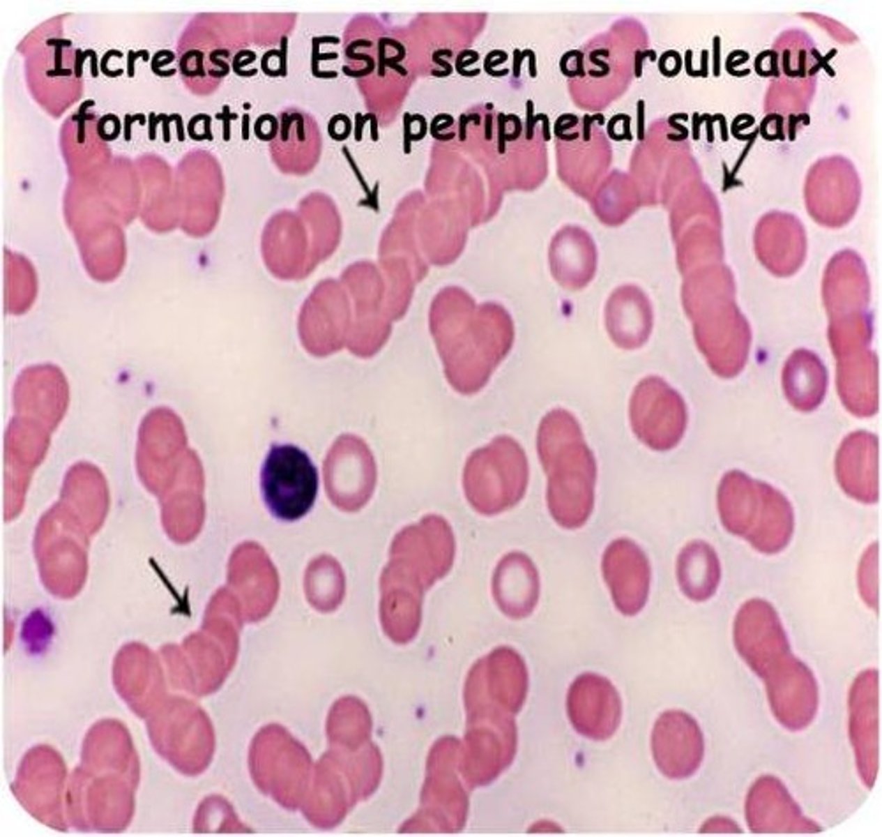 <p>- RBCs are stacked like rolls of coins (think grapes)</p><p>- increase plasma proteins &gt; sticking at RBCs &gt; neutrlizing of sialic acid &gt; stacking of RBCs</p><p>- Etiologies:</p><p>Multiple myeloma</p><p>Waldenstrom's</p>