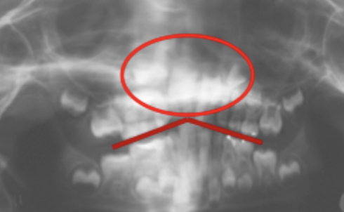 <p>Patient position - Vertical error 2</p>