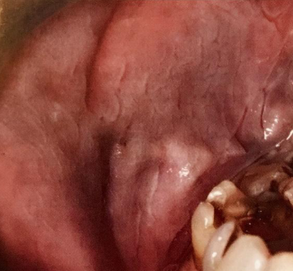 <p>generalized gray-white film, common in AFRICAN AMERICAN individuals, becomes less prominent when mucosa is stretched</p>