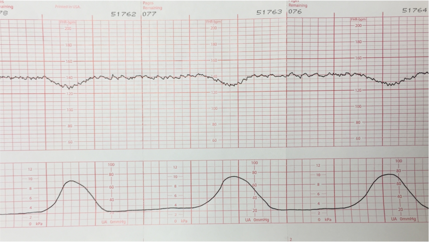 <p>Repetitive and periodic slowing of the FHR with onset early in the contraction and return to baseline at the end of the contraction</p><p>These are uncommon</p>