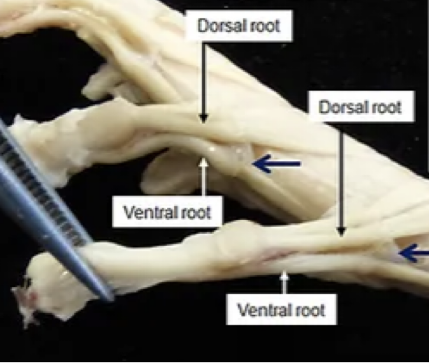 <p>DORSAL ROOT GANGLIONS</p><ul><li><p>Each dorsal root contains a spinal ganglion (aggregation of cell bodies) OUTIDE OF THE CNS&nbsp;</p></li><li><p>Will see a bulging at the dorsal root; collection of neurons&nbsp;</p></li><li><p>Is the exception; all neurons are INSIDE of the CNS EXCEPT for these!!</p></li></ul><p></p>