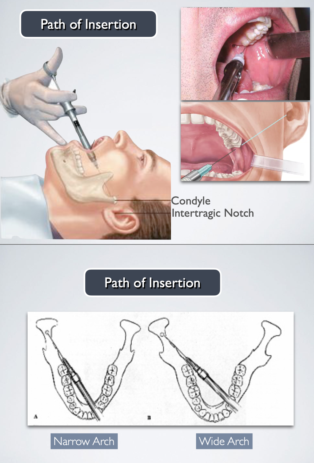 <ul><li><p>Thumb palpating the anterior border of the ramus Index finger over the intertragic notch of the ear</p></li><li><p>This line forms the path of insertion</p></li><li><p>Advance the needle slowly until bone is contacted</p></li><li><p>Target: The bone contacted is the neck of the condyle</p></li><li><p>Average depth of needle insertion is about 25 mm</p></li></ul><p></p>