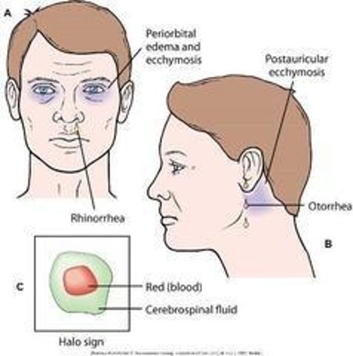 <p>Battle's sign, raccoon eyes, CSF rhinorrhea, CSF otorrhea, and the halo sign.</p>