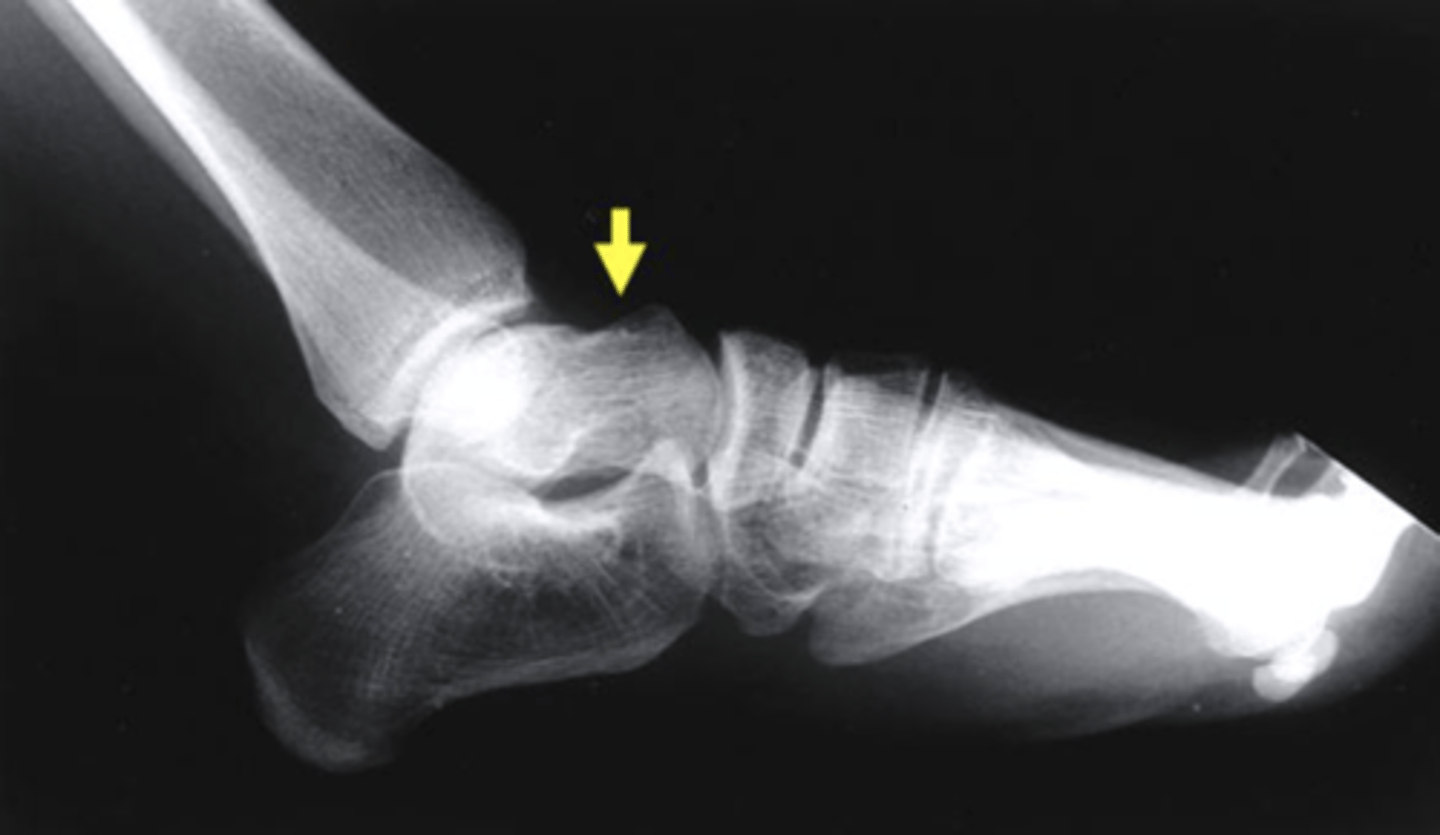 <p>talus</p><p>3 multiple choice options</p>